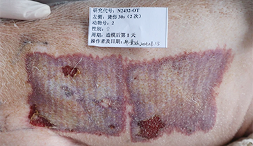 深I(lǐng)I度燙傷模型